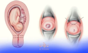 عکس سرکلاژ | خوابیدن بعد از عمل سرکلاژ