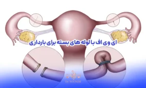 ای وی اف با لوله های بسته و عکس لوله های بسته
