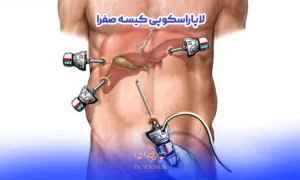 عکس لاپاراسکوپی صفرا