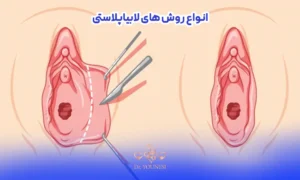 عکس لابیاپلاستی با جراحی در انواع لابیاپلاستی