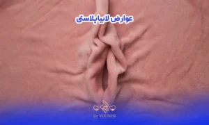 پارچه شبیه به لابیا در عوارض لابیاپلاستی