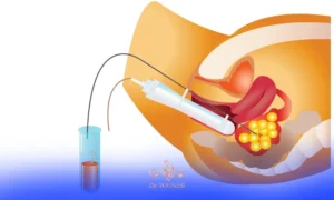 عکس عمل پانکچر یا تخمک کشی