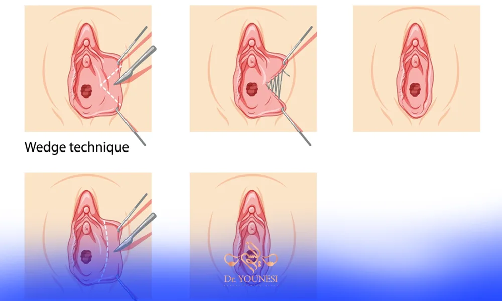 عوامل مؤثر بر قیمت عمل لابیاپلاستی