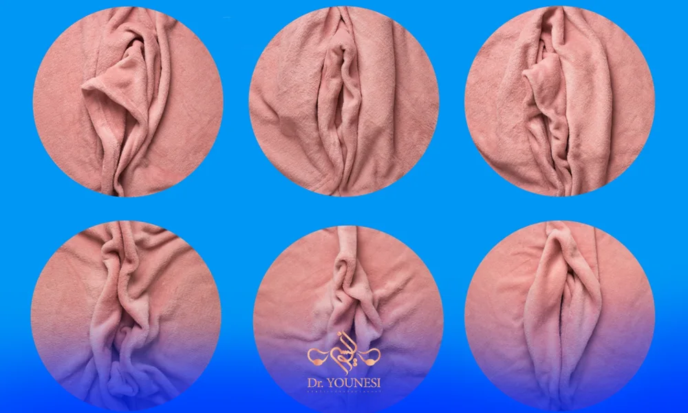 هزینه عمل زیبایی واژن یا قیمت عمل لابیاپلاستی