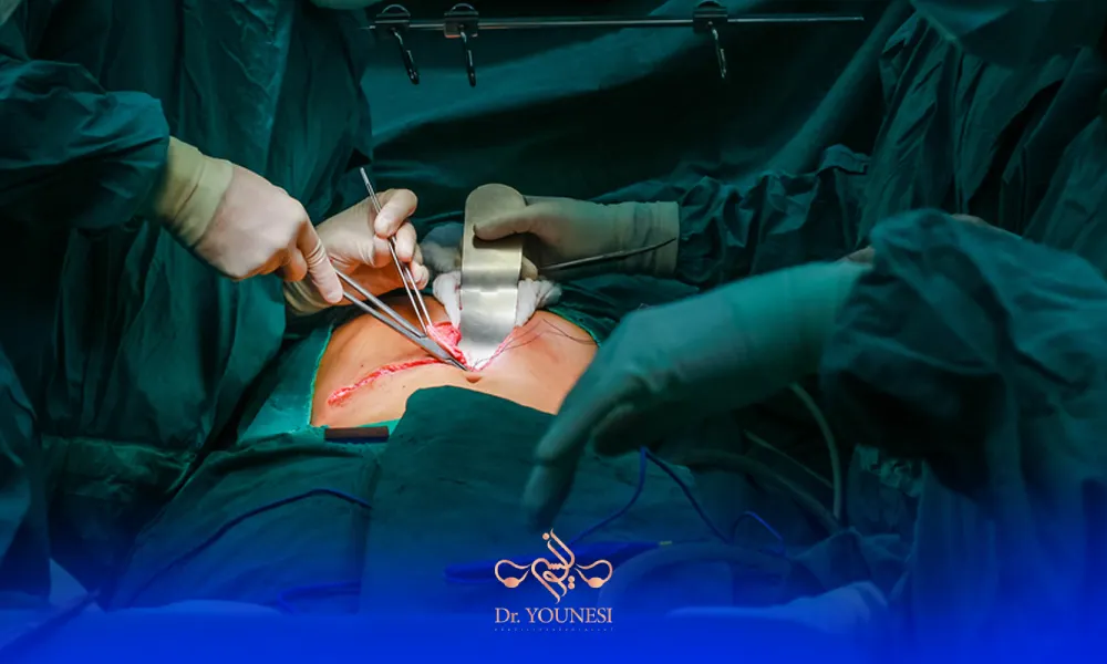 عوارض لاپاراتومی در جراحی های مختلف شکمی