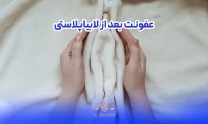 عفونت بعد از لابیاپلاستی