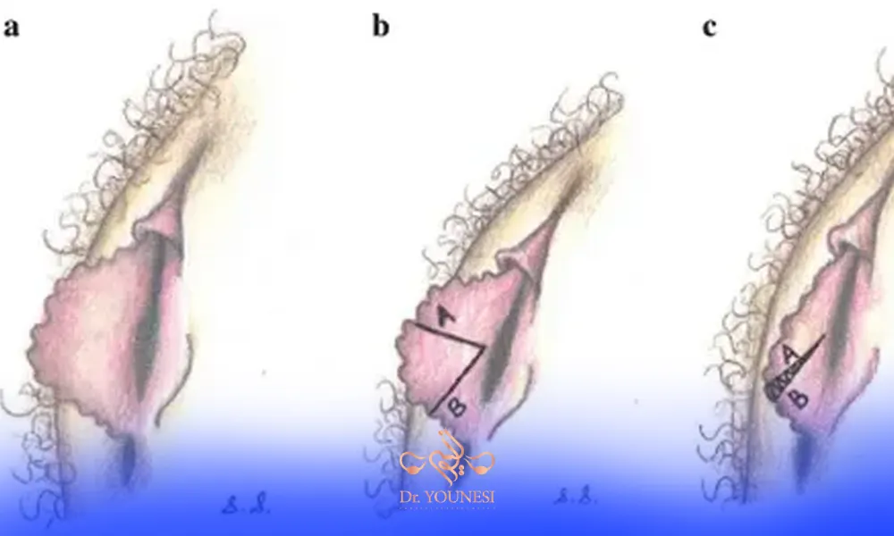 مراقبت های بعد از لابیاپلاستی با جراحی