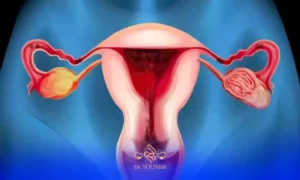 تنبلی تخمدان و مراقبت های پیشگیرانه ناباروری