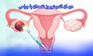 درمان اندومتریوز تخمدان با جراحی