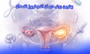بهترین روش درمان اندومتریوز تخمدان