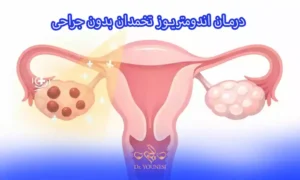 درمان اندومتریوز تخمدان بدون جراحی