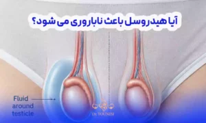 آیا هیدروسل باعث ناباروری می شود