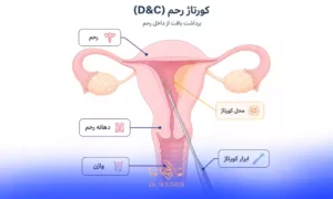 هزینه عمل کورتاژ در شهرهای مختلف ایران