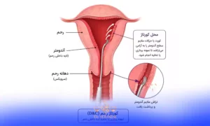 عوامل مؤثر بر هزینه عمل کورتاژ