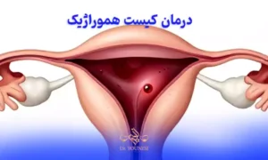 درمان کیست هموراژیک چگونه انجام می شود؟