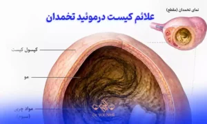 علائم کیست درموئید تخمدان
