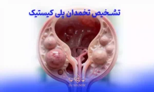 تشخیص تخمدان پلی کیستیک چگونه انجام می شود؟