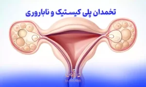 تخمدان پلی کیستیک و ناباروری