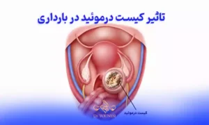 تاثیر کیست درموئید در بارداری