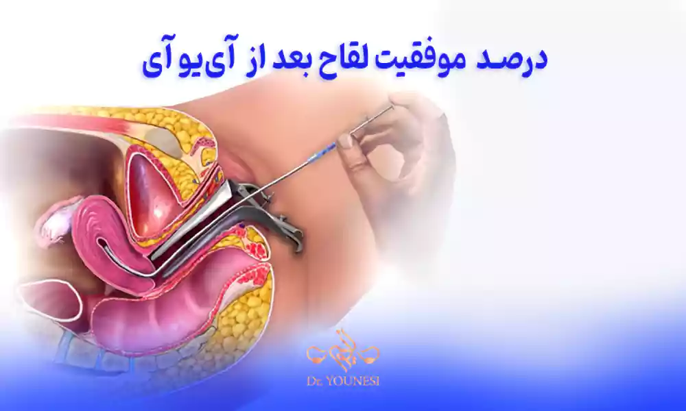 از کجا بفهمیم لقاح بعد از IUI با موفقیت انجام شده است