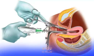 کورتاژ ضخامت دیواره رحم