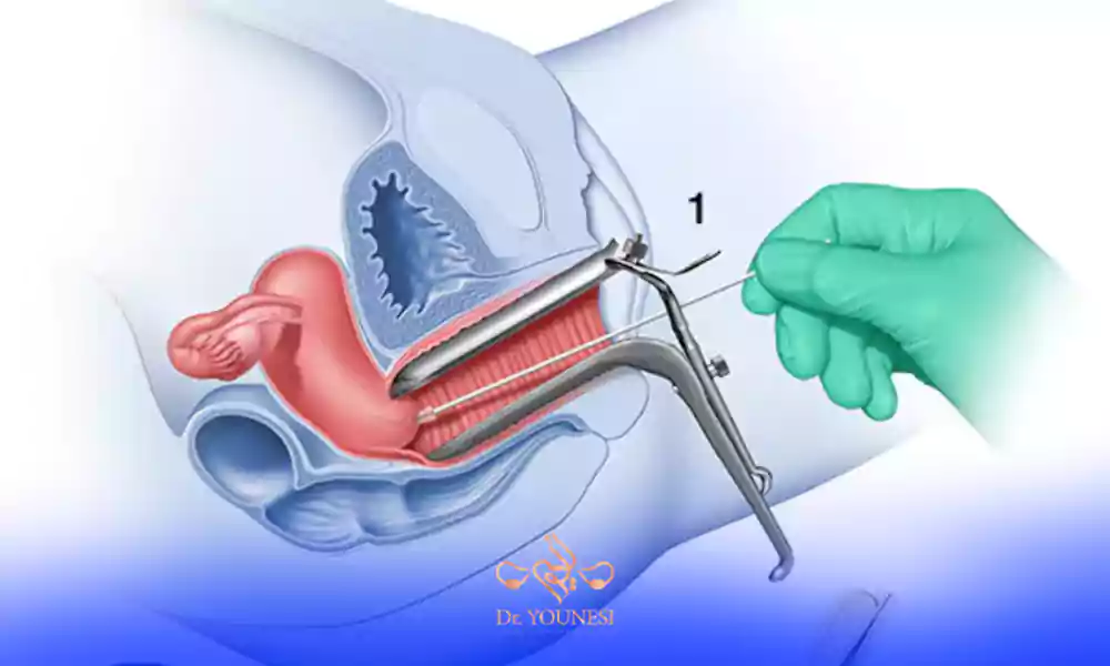 نحوه کورتاژ ضخامت دیواره رحم