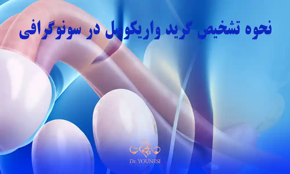 نحوه تشخیص گرید واریکوسل در سونوگرافی