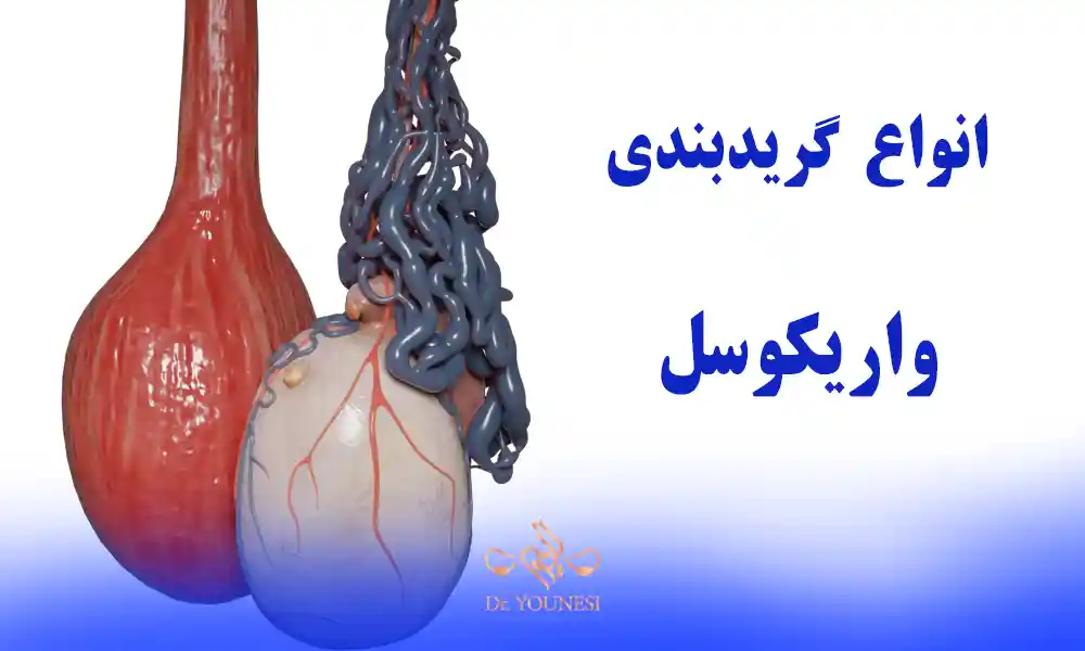 انواع گریدبندی واریکوسل