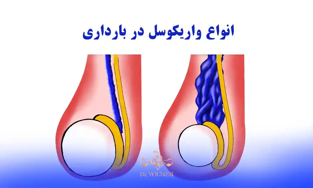 انواع واریکوسل در بارداری و انواع عمل واریکوسل