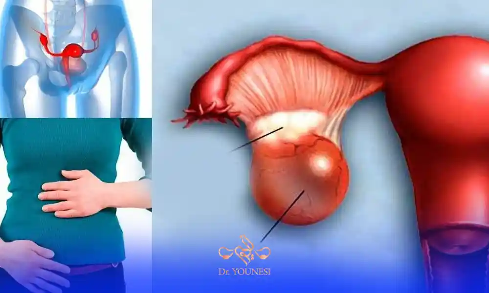 علائم کیست هموراژیک تخمدان
