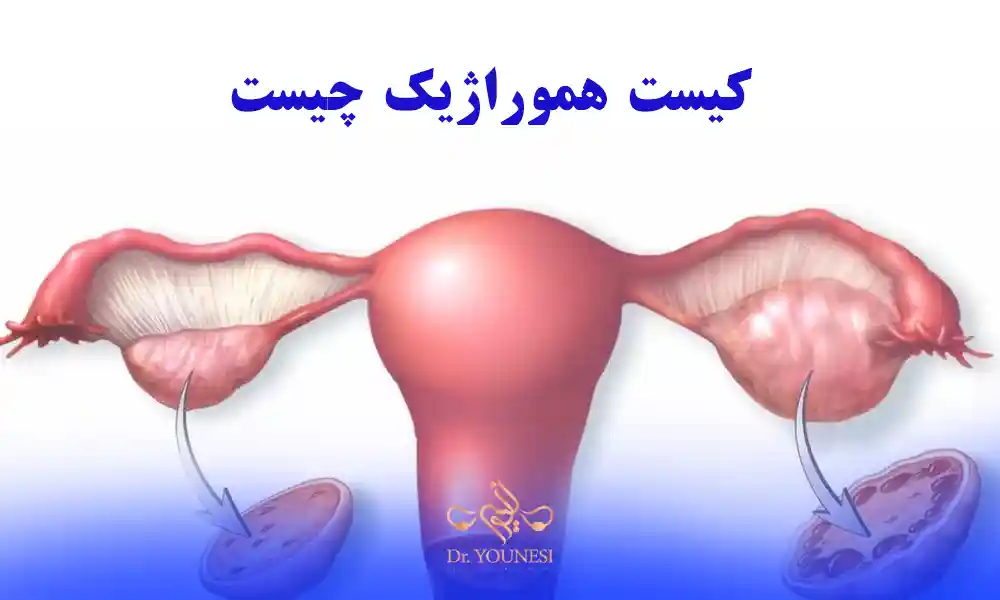 چه کسانی بیشتر مبتلا به کیست هموراژیک می شوند؟