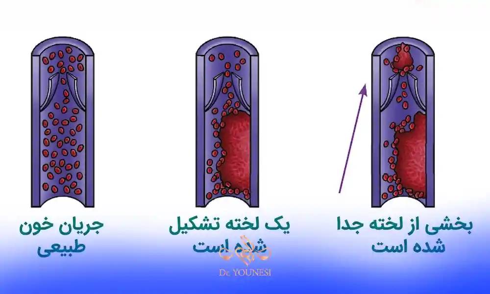 لخته خون در پریودی چه زمانی خطرناک است و باید به پزشک مراجعه کرد؟